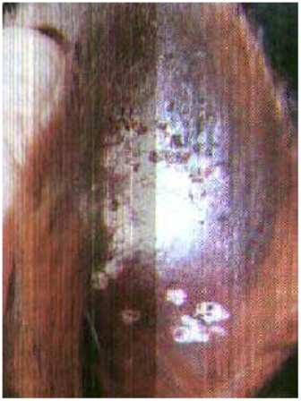 La mosca negra (como otros insectos) contribuye a la transmisión (De caballo a caballo del virus) de las “Placas aureales” (lesiones blancas de tamaño variable dentro de la oreja) ocasionando daño en la piel debido a la invasión viral.